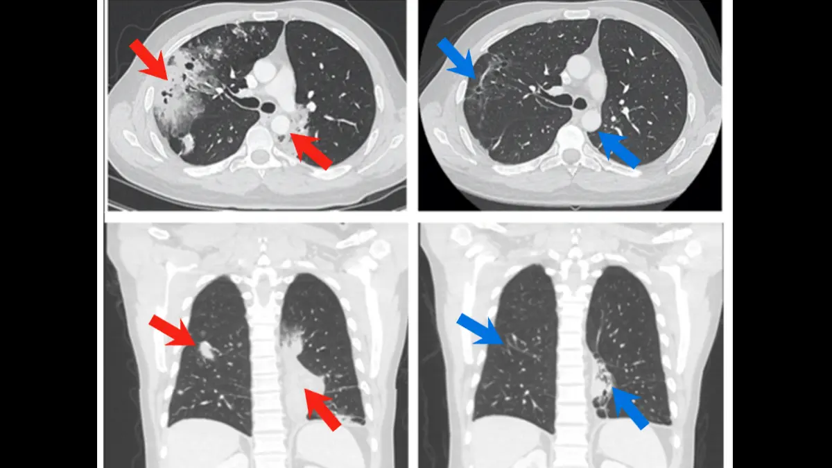 CT scans of a patient's chest illustrate how cancer has shrunk after treatment.