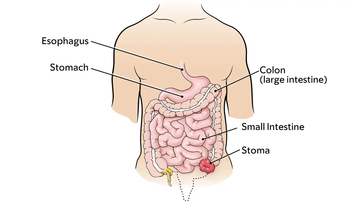 Diagram of the colon, intestine, stomach, and a colostomy stoma 