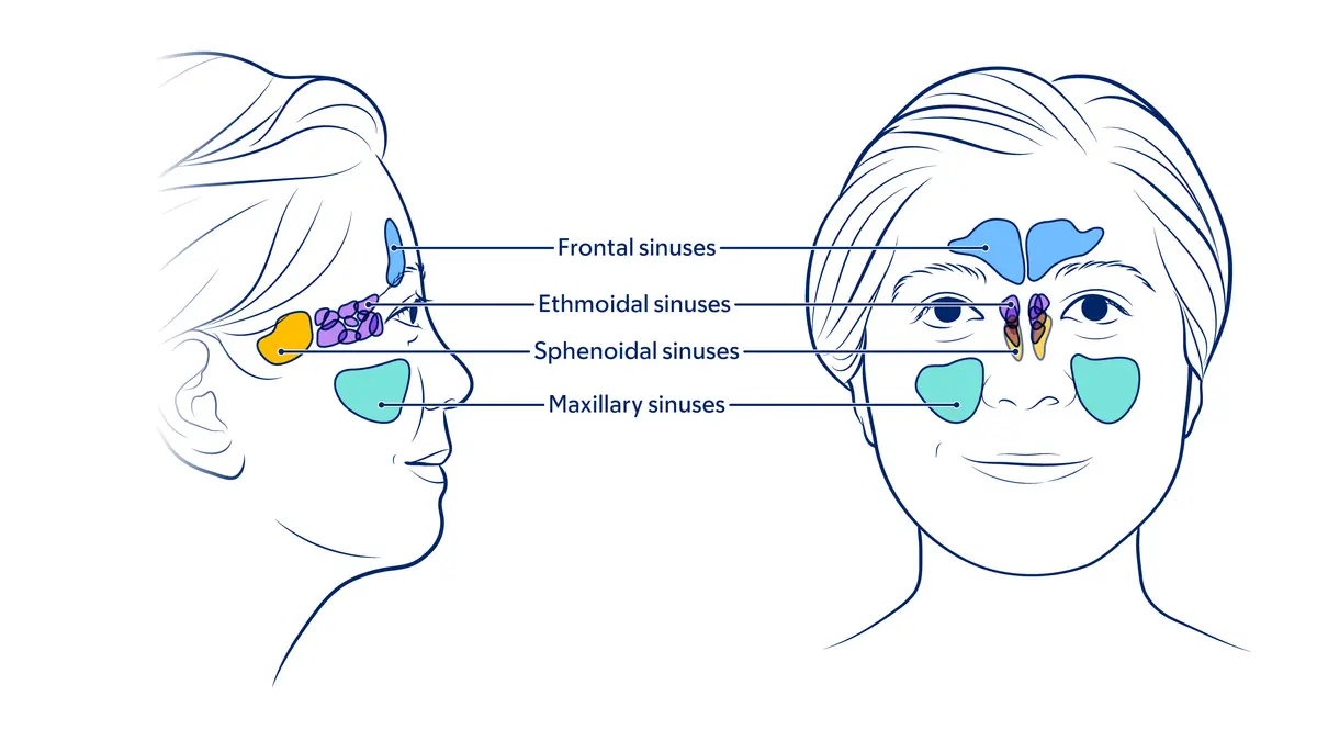 Illustration of sinuses in the face, showing frontal, ethmoidal, sphenoidal, and maxillary. 