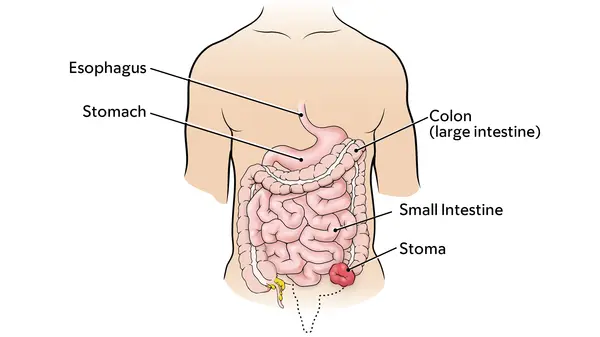 Colostomy stoma shown with the rest of the digestive system, the esophagus, stomach, large, and small intestine. 