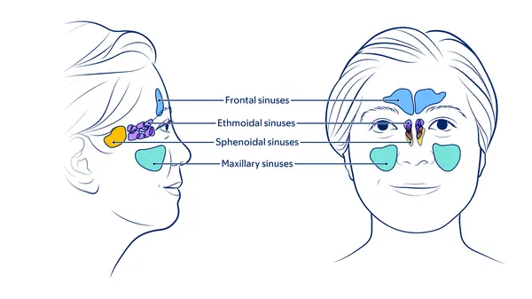 Illustration of sinuses in the face, showing frontal, ethmoidal, sphenoidal, and maxillary. 
