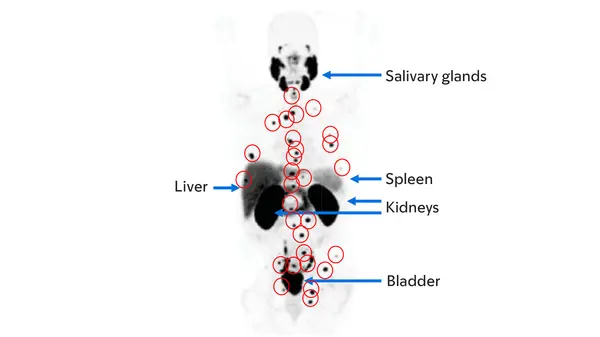 A PSMA PET scan with labeled parts of the body and many red circles that show where there are prostate cancer cells.  